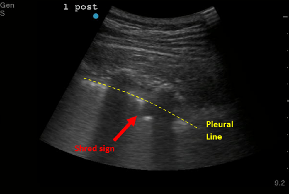 ‘Shred-sign’,-also-known-as-fractal-sign-(labeled-with-an-arrow)-and-pleural-line-(labeled-with-a-dotted-line)