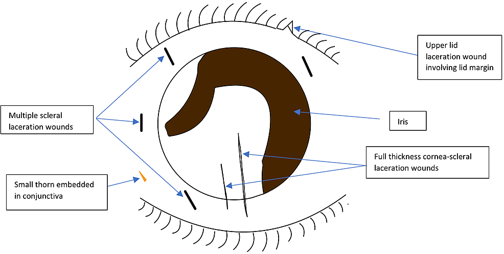Illustration-of-intraoperative-findings-showing-the-sites-of-the-corneal-and-scleral-lacerations-with-loss-of-the-half-of-the-iris-tissue-inferiorly-and-iridodialysis-at-9–11-o’clock.