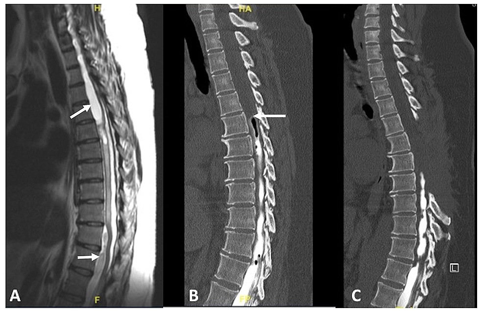 Cerebral arachnoiditis of the brain: symptoms, treatment, consequences Cerebral arachnoiditis of the brain: symptoms, treatment, consequences