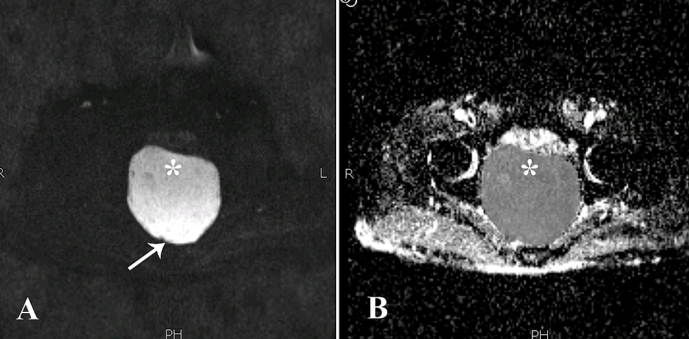 A Rare Case Of Presacral Epidermoid Cyst In An Adult Male Emphasis On Diffusion Weighted 2753