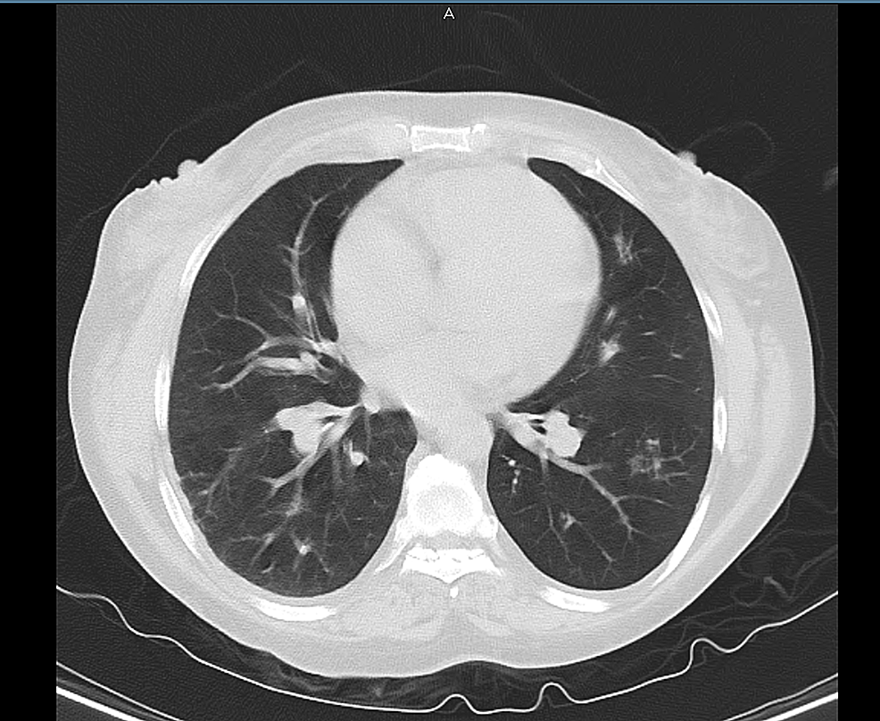 CT-chest-showing-no-consolidation-and-emphysematous-changes-due-to-COPD.-Incidental-finding-of-small-GGO-in-the-left-lower-lobe.