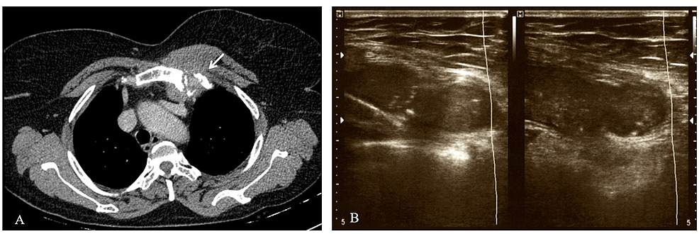 -(A)-CT-scan-of-neck-region-showing-(arrow)-the-necrotic-destruction-of-left-sternoclavicular-joint-with-involvement-of-adjacent-soft-tissue.-(B)-USG-showing-the-fluid-filled-swelling-with-a-needle-in-situ-for-aspiration.