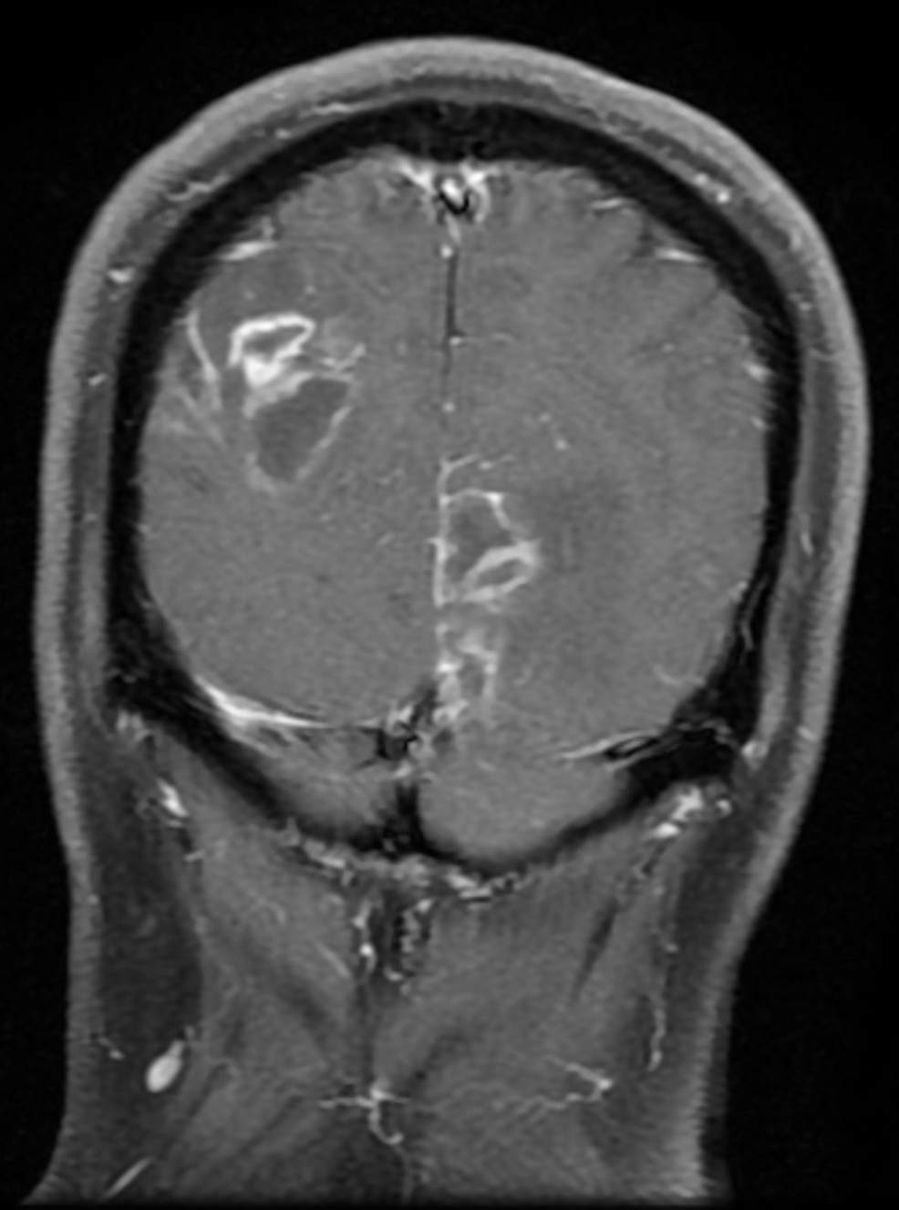 Multiple-ring-enhancing-lesions-noted-in-a-coronal-section-of-brain-MRI