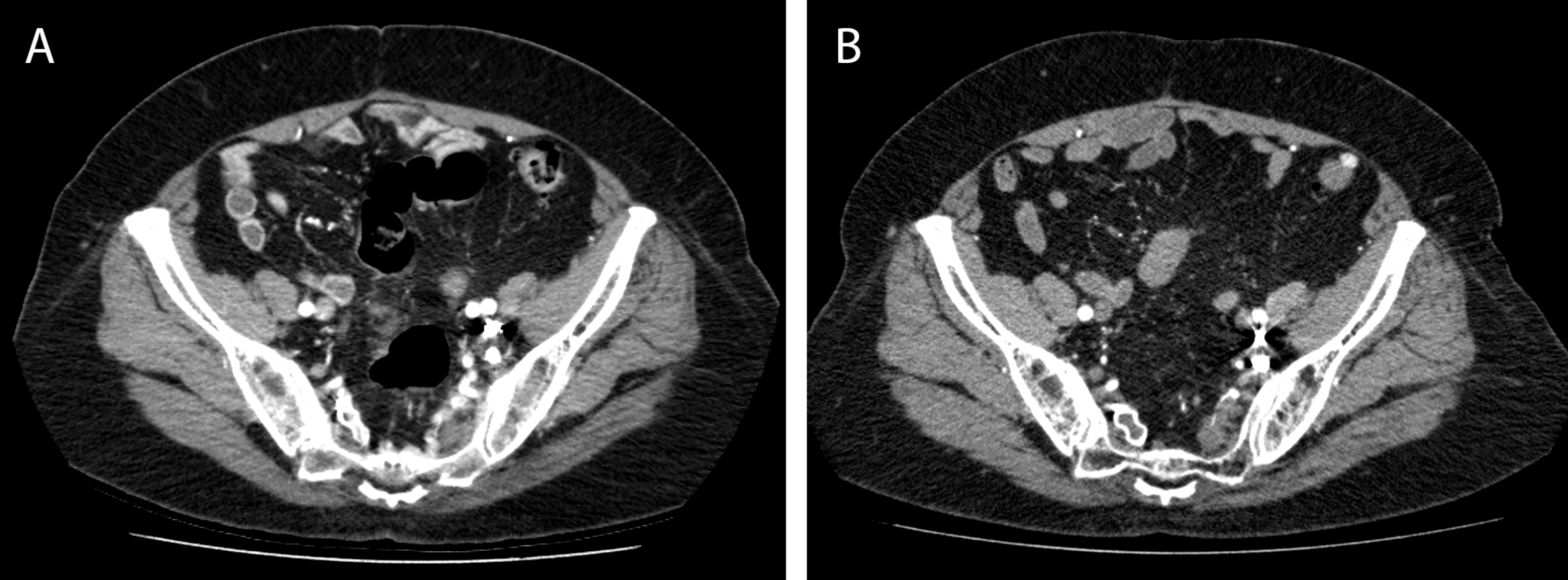 Cureus | Stereotactic Body Radiotherapy (SBRT) for an Extracranial ...