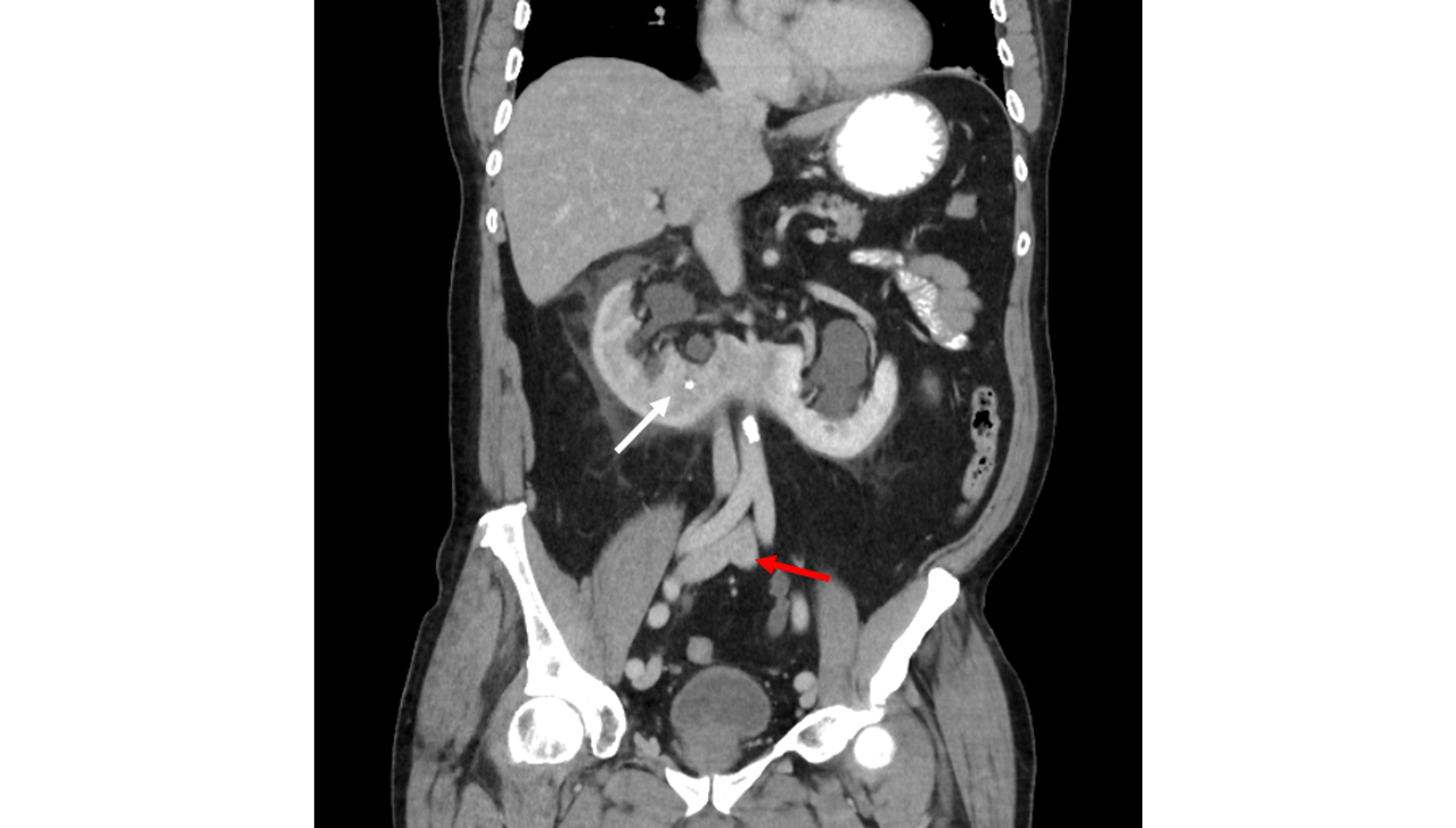 Cureus Anomalous Circumrenal Inferior Vena Cava Associated With