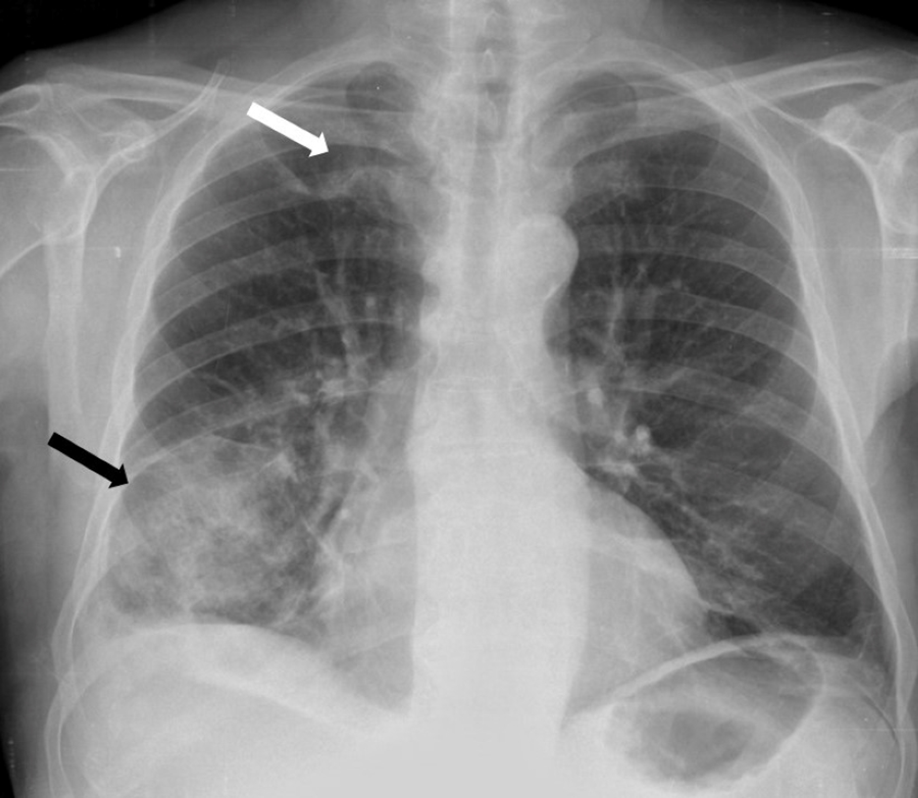 Cureus | Right-Side Endocarditis: A Typical Presentation in an Atypical ...