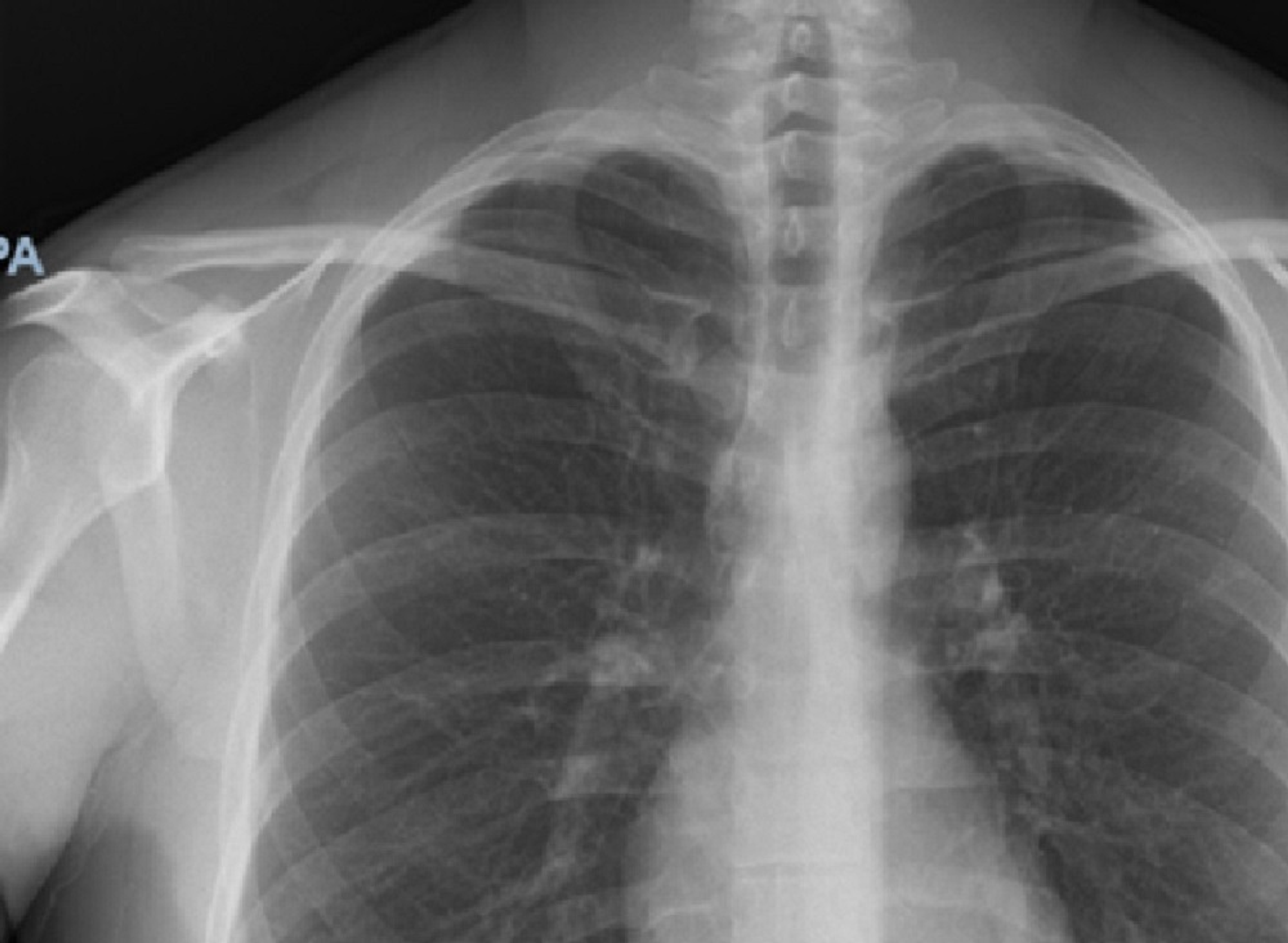 Cureus A Case of Multifactorial Viral Myocarditis