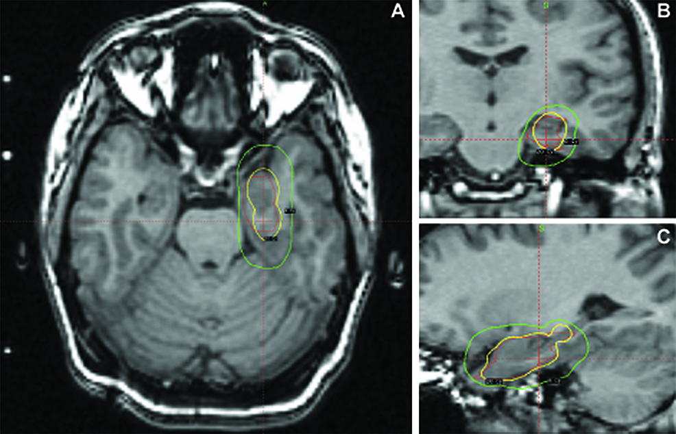 Cureus Radiationinduced Cavernous Malformation as a Late Sequelae of Stereotactic