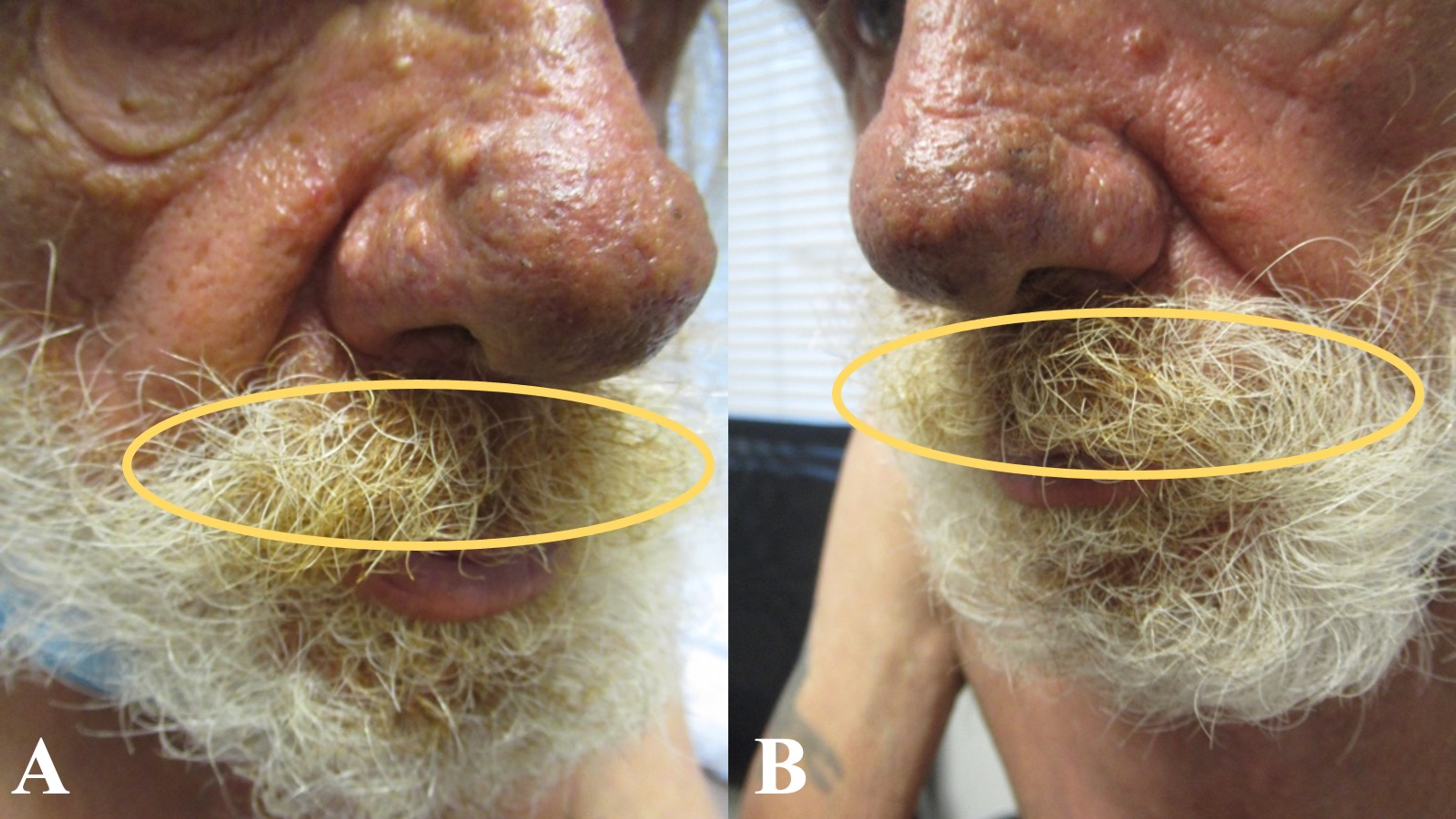 Cureus | Smoker's Mustache Revisited: Upper Lip Hair Yellow Discoloration Associated With Tobacco | Article Cureus | Smoker's Mustache Revisited: Upper Lip Hair Yellow Discoloration Associated With Tobacco | Article