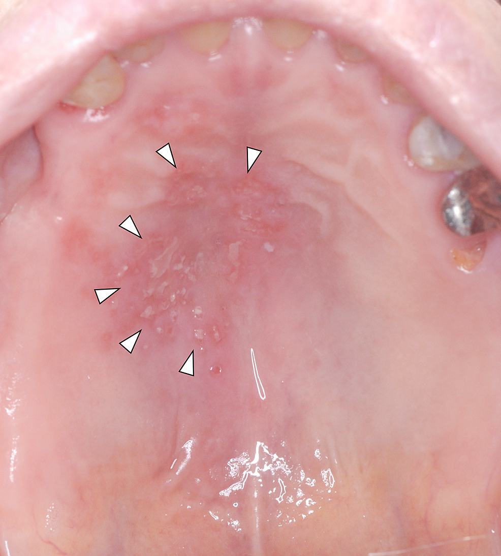 A-mirror-image-of-the-multiple-unilateral-herpes-zoster-on-the-left-hard-palate-(arrowheads)