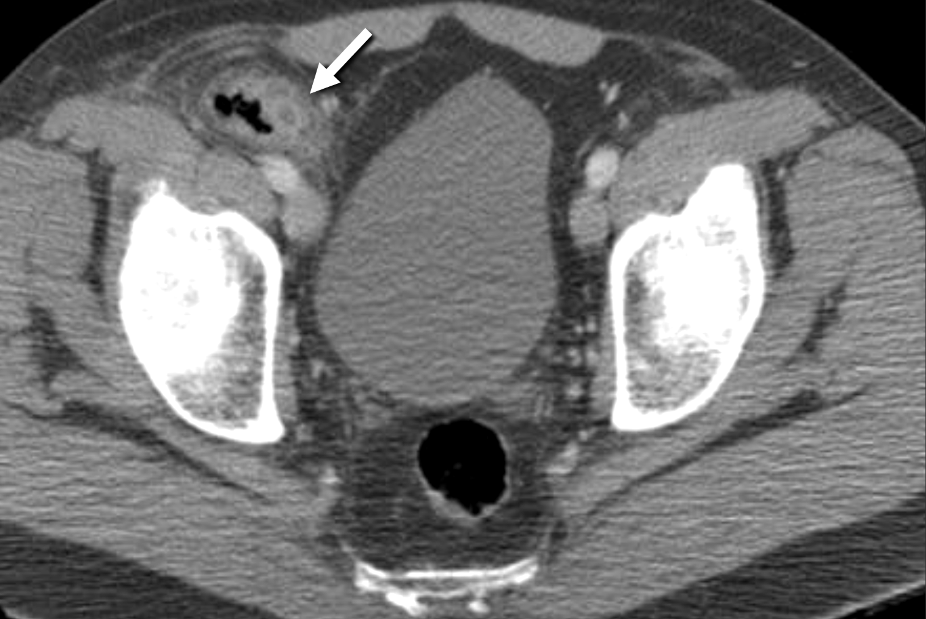 Cureus Amyand Hernia With Acute Appendicitis A Rare Type Of Hernia