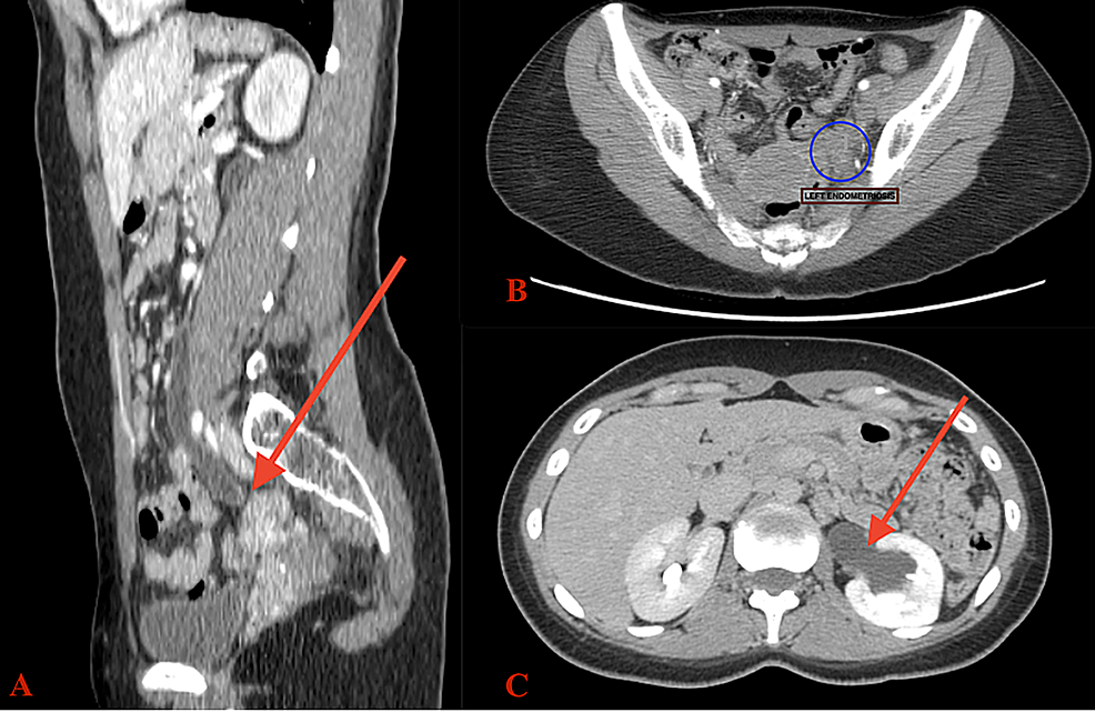 b: Tract filled with blood stained fluid and endometriosis.