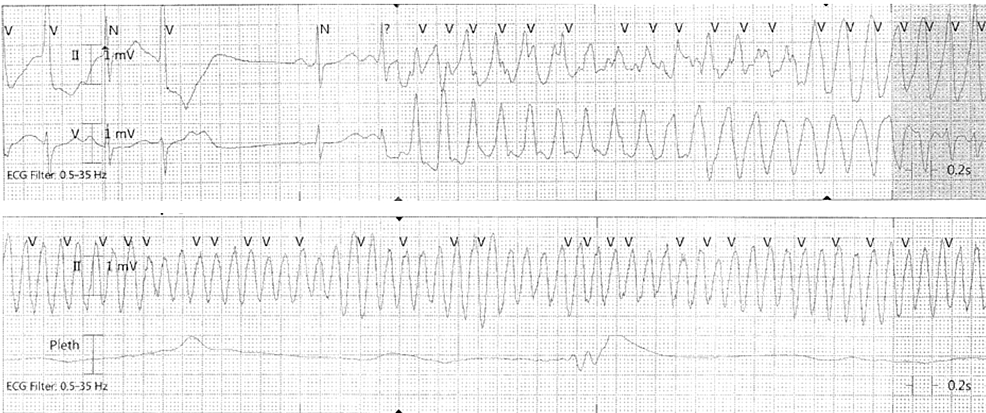 Cureus | A Case of Abiraterone-Related Hypokalemia Leading to Torsades ...