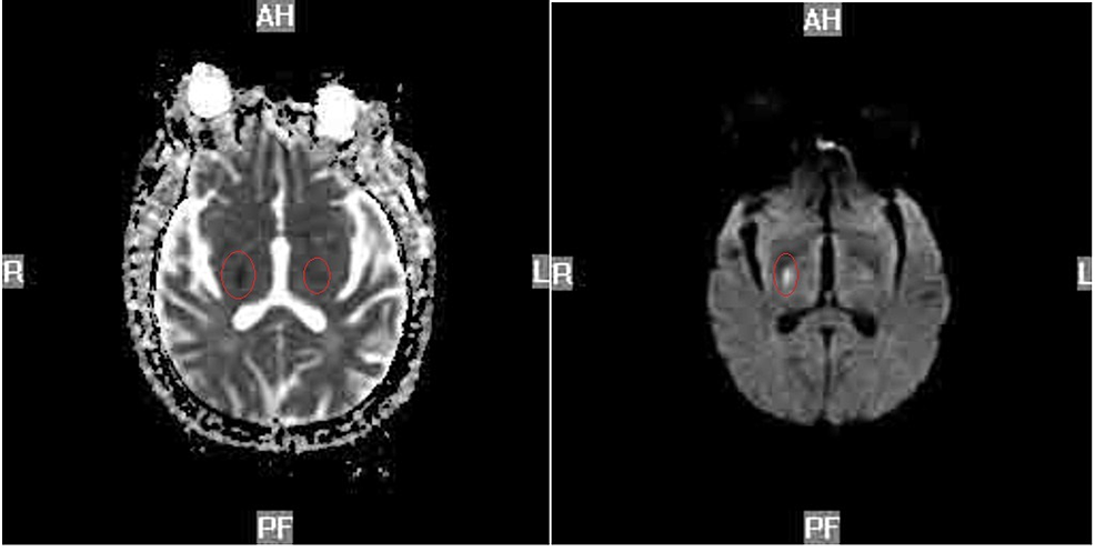 Diffusion-weighted-MRI-head-(left).-Axial-MRI-of-the-head-(right)