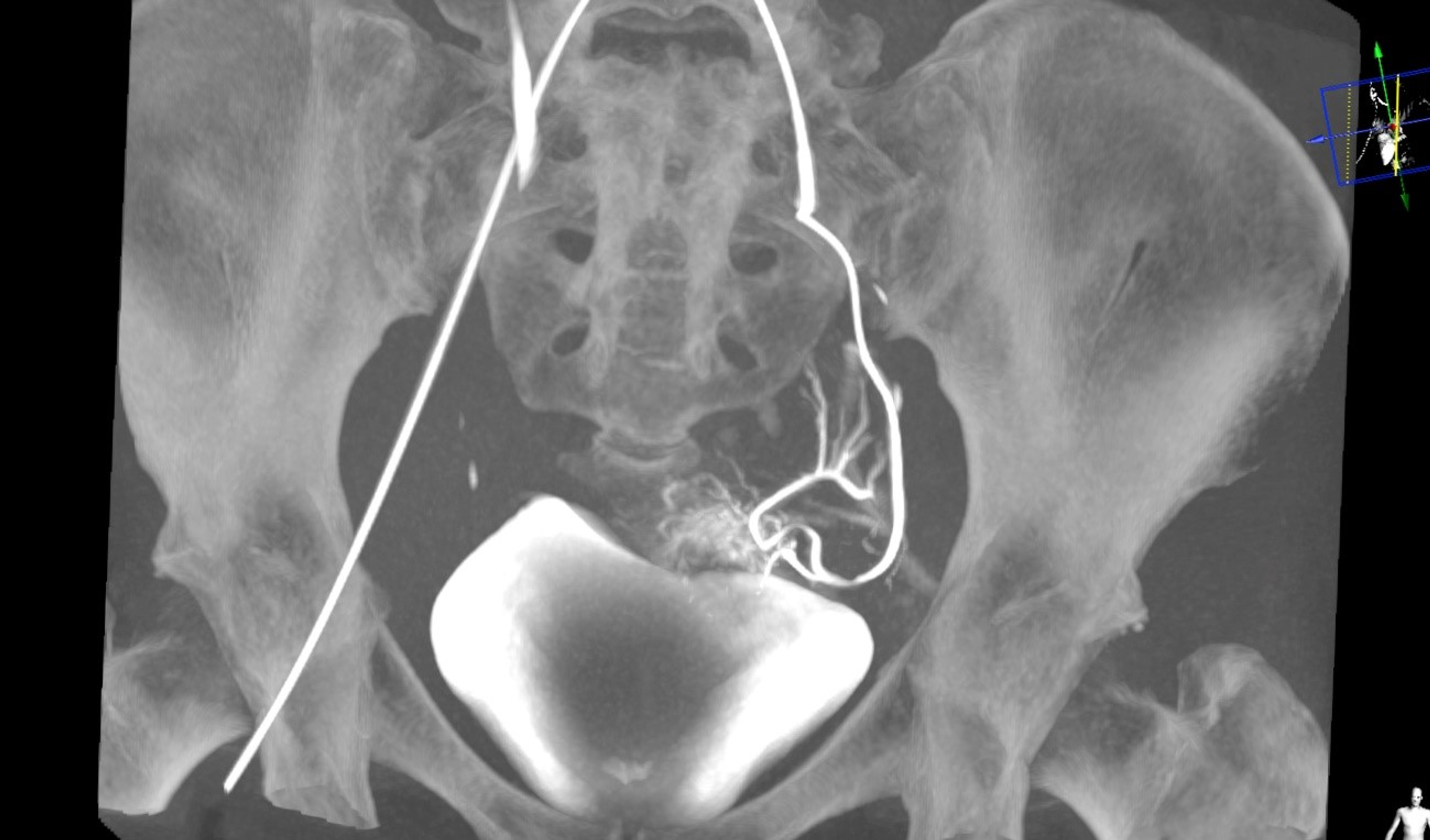 Cureus | Cervical Ectopic Pregnancy: A Multidisciplinary Approach