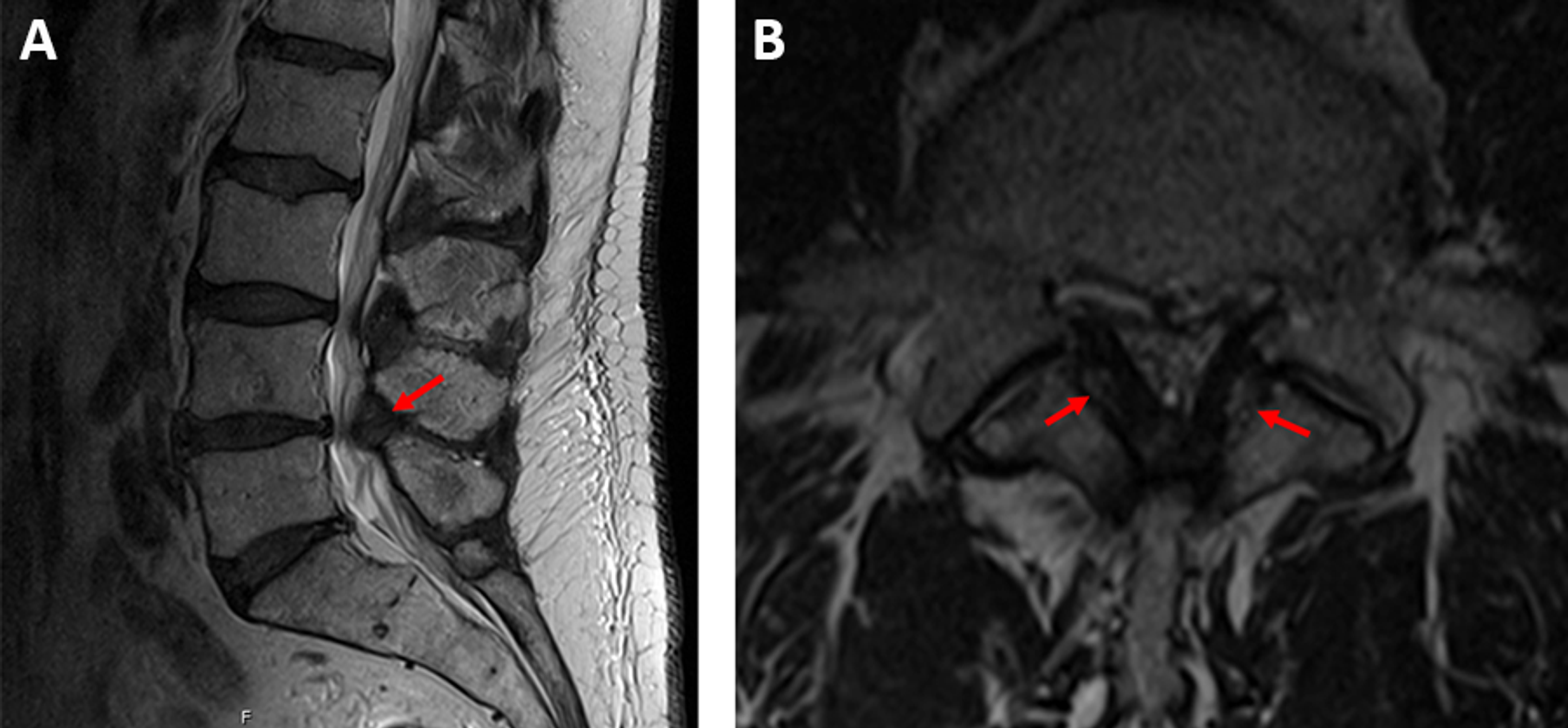 Cureus Ossification of the Ligamentum Flavum of the Lumbar Spine