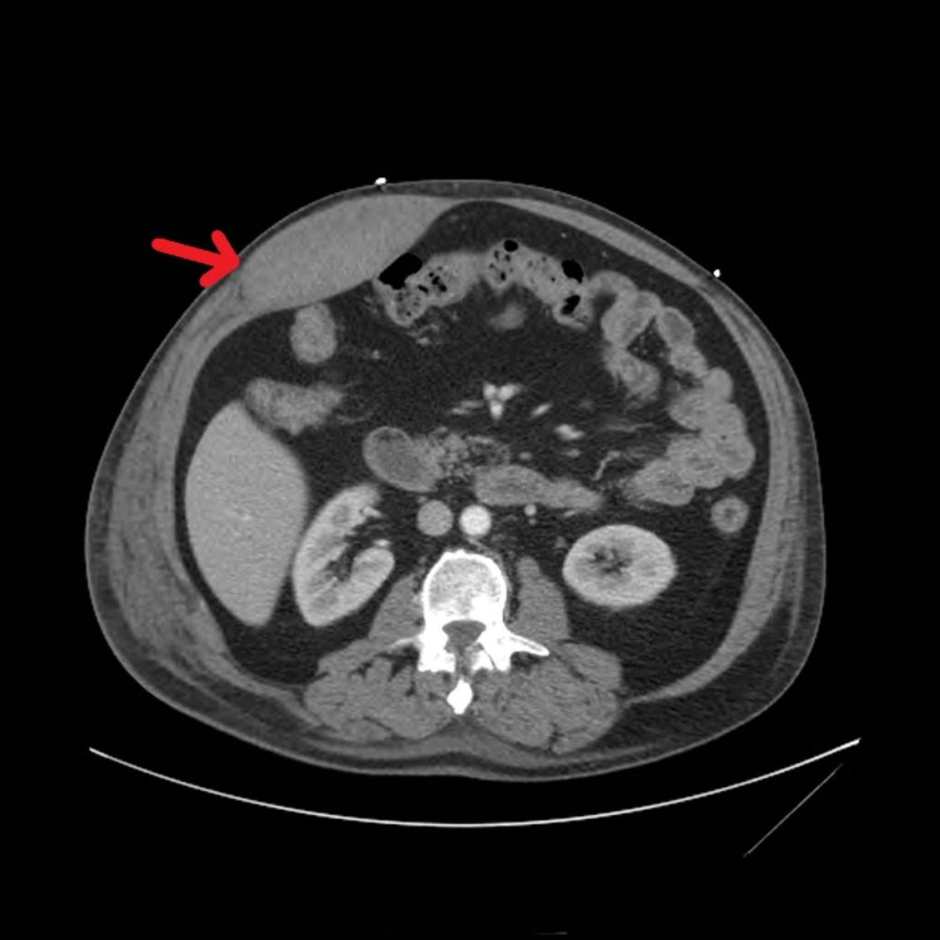 Cureus Formation of a Rectus Sheath Hematoma Secondary to COPD