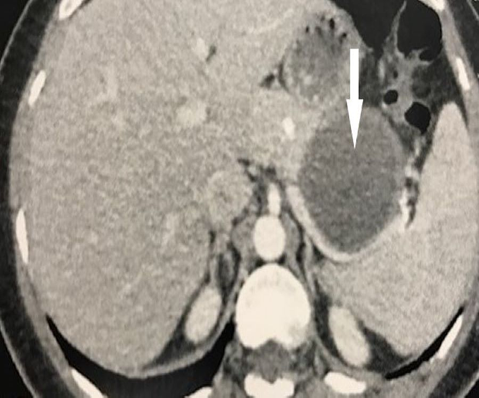 Cureus Gastric Duplication Cyst Revealed After An Endoscopic