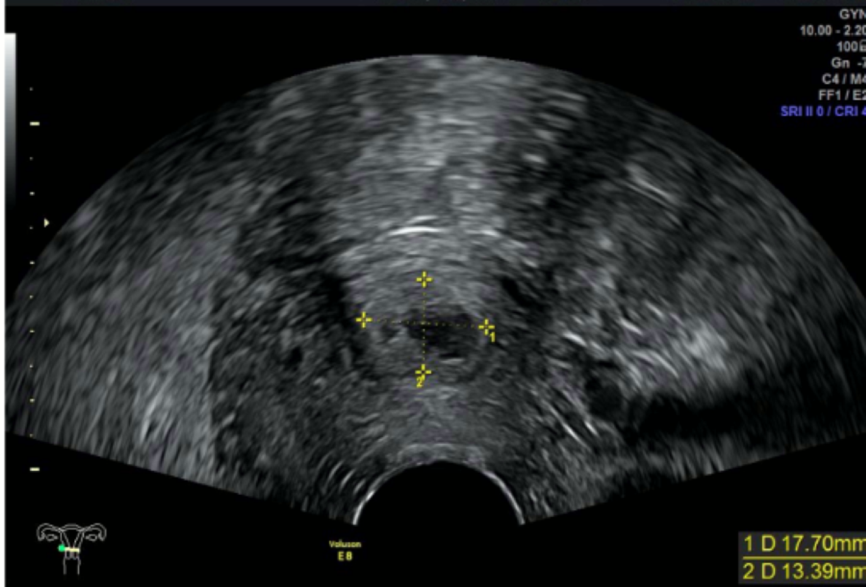 Cureus | Cervical Ectopic Pregnancy: A Multidisciplinary Approach