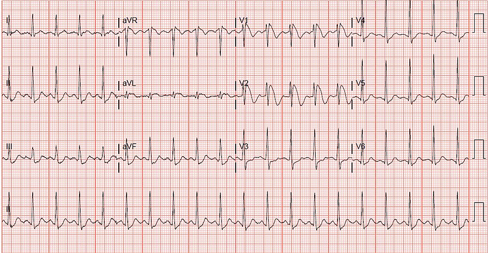 Cureus | Brugada Electrocardiogram Pattern Induced by Recreational ...