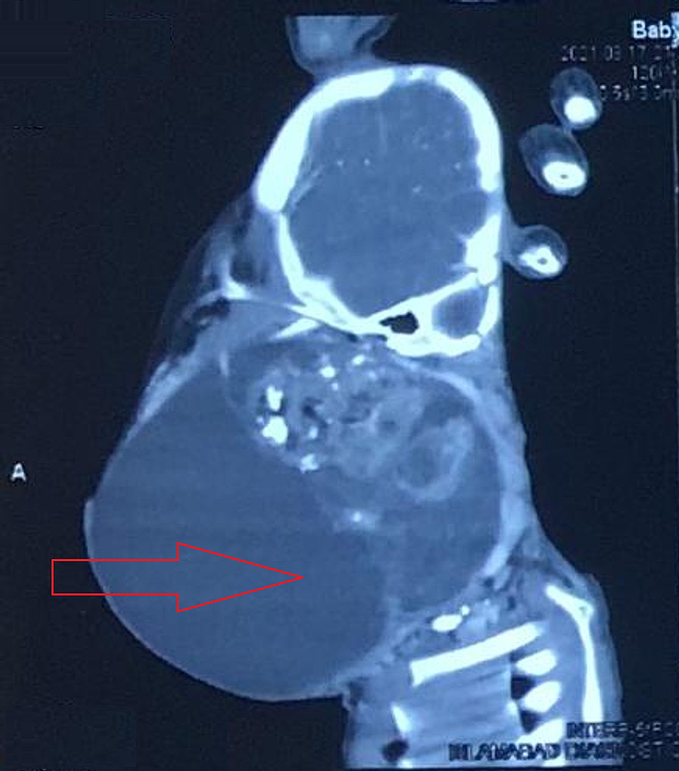 cureus-cervical-cystic-teratoma-an-unusual-cause-of-airway