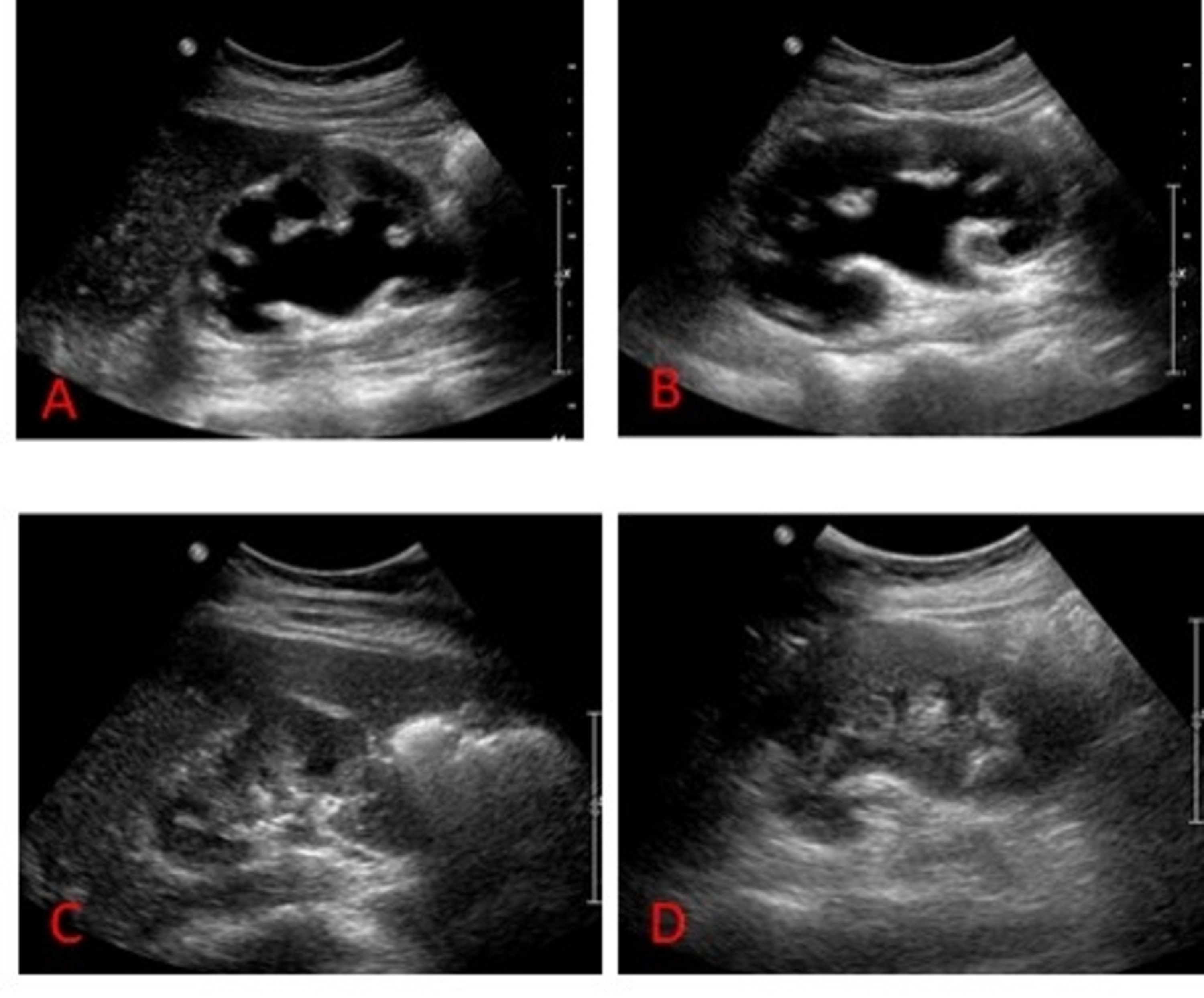Nephrostomy Tube Ultrasound