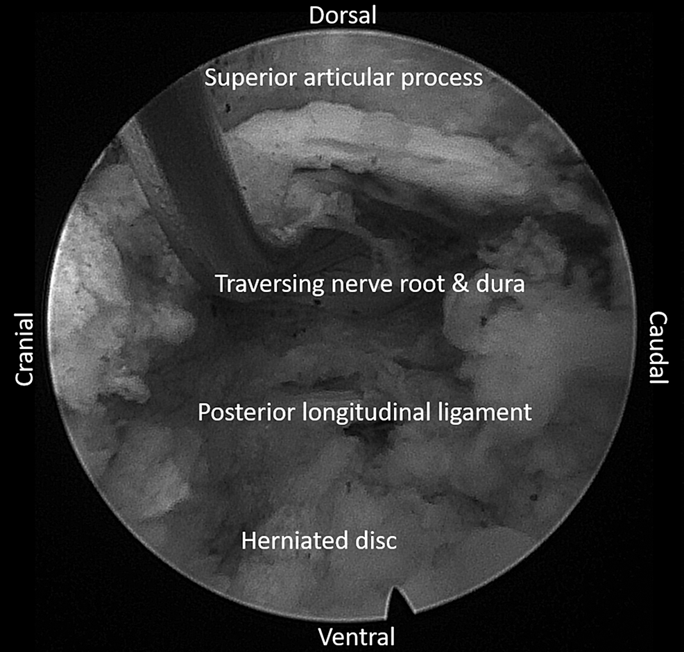 Endoscopic-image-of-the-transforaminal-approach-to-the-epidural-space
