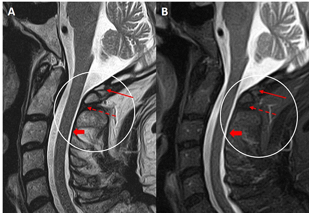 Cureus C1C2 Dorsal Epidural Hematoma on Cervical Spine CT A Novel Imaging Sign of Posterior