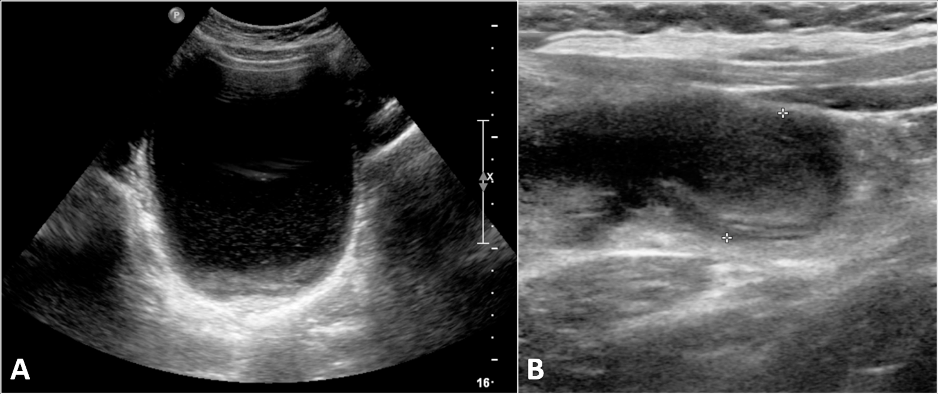 left-iliac-fossa-pain-iliac-fossa-pain-acute-right-62-vrogue-co