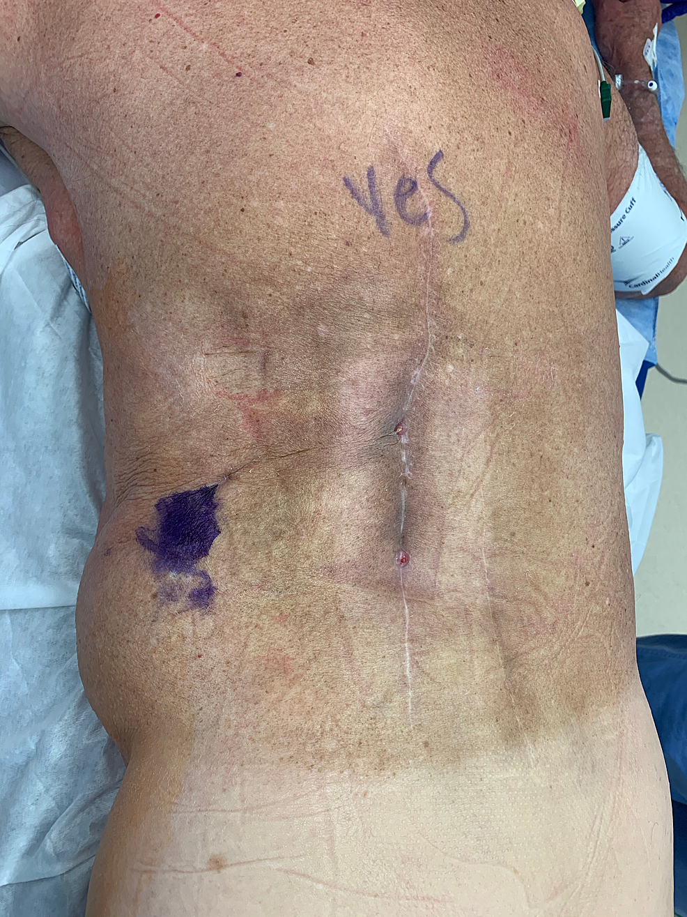 Left-lower-back-wound-showing-previous-incision-and-the-chronic-draining-sinus-in-the-incision.-The-purple-marks-where-the-mental-flap-was-tunneled-posteriorly.-