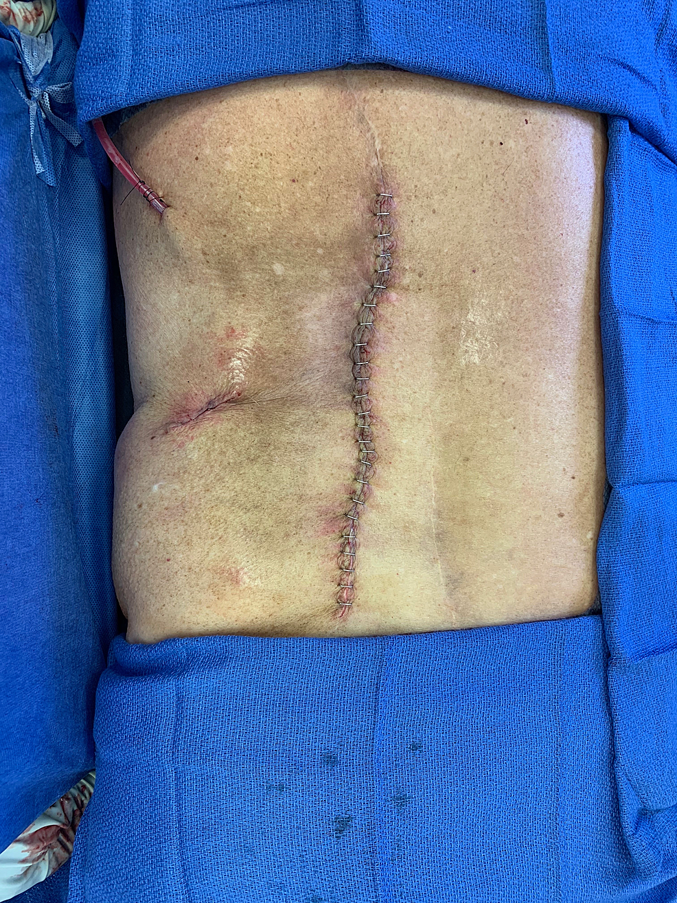 Final-closure-after-the-sinus-track-and-the-necrotic/radiated-tissue-was-excised-and-the-mental-flap-was-draped-into-the-wound.-A-JP-drain-was-placed-into-the-wound-and-the-overlying-skin-flaps-were-brought-together-there-and-closed.-