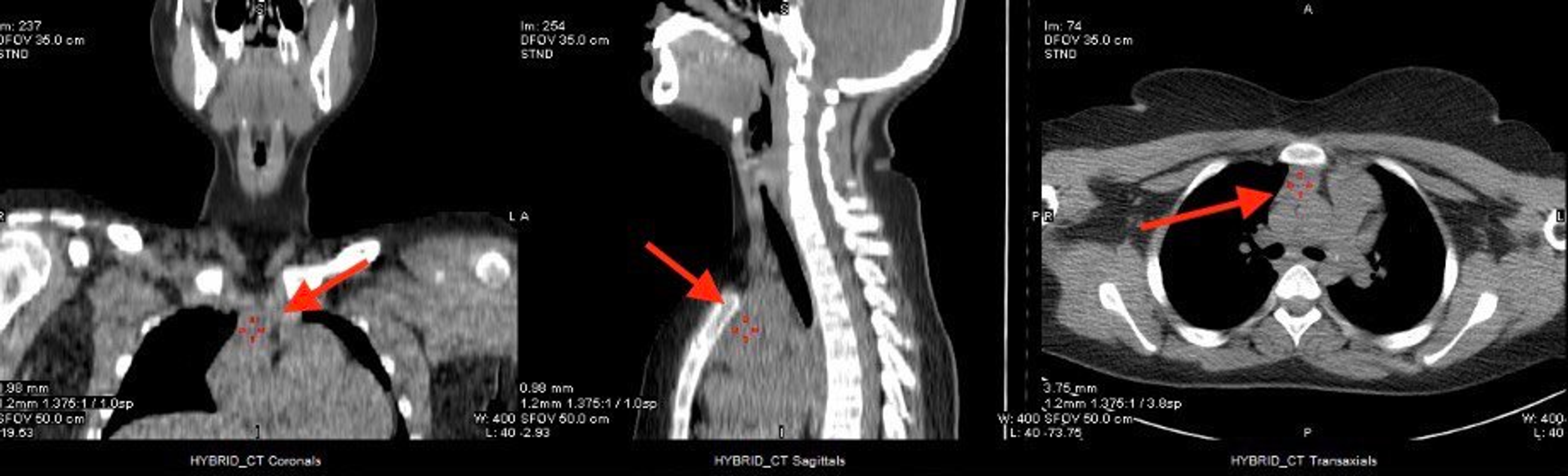 Cureus Primary Hyperparathyroidism as a Rare Cause of Unexplained