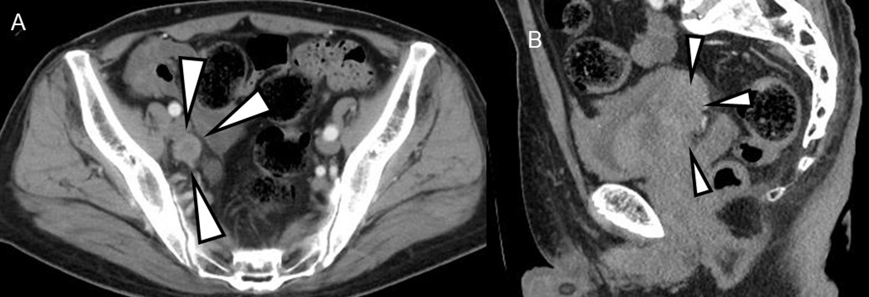 Cureus | A Case Of Muscle-Invasive Bladder Cancer With Pelvic Lymph ...