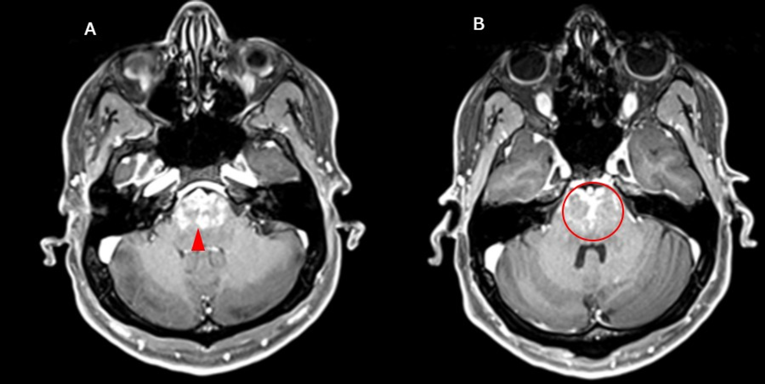 Cureus | Chronic Lymphocytic Inflammation With Pontine Perivascular ...