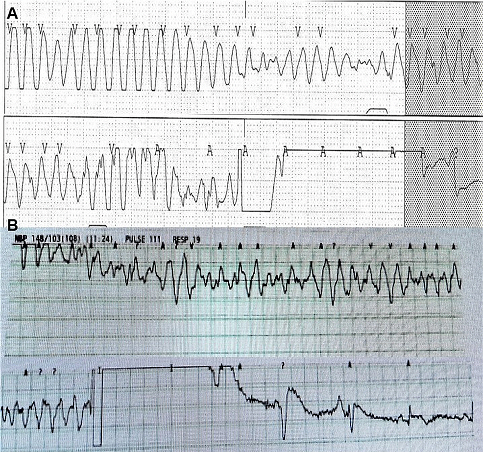 Cureus Ventricular Arrhythmia Associated With Magnesium and Vitamin D