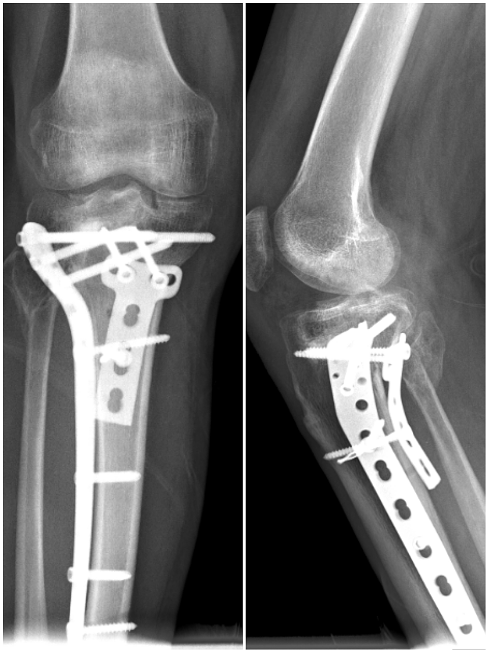 Cureus | Comparative Analysis of Single Lateral Locked Plate and Double ...