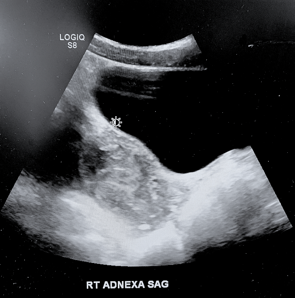 Pelvic-ultrasound-showing-heterogenous-mass-adjacent-to-right-ovary.