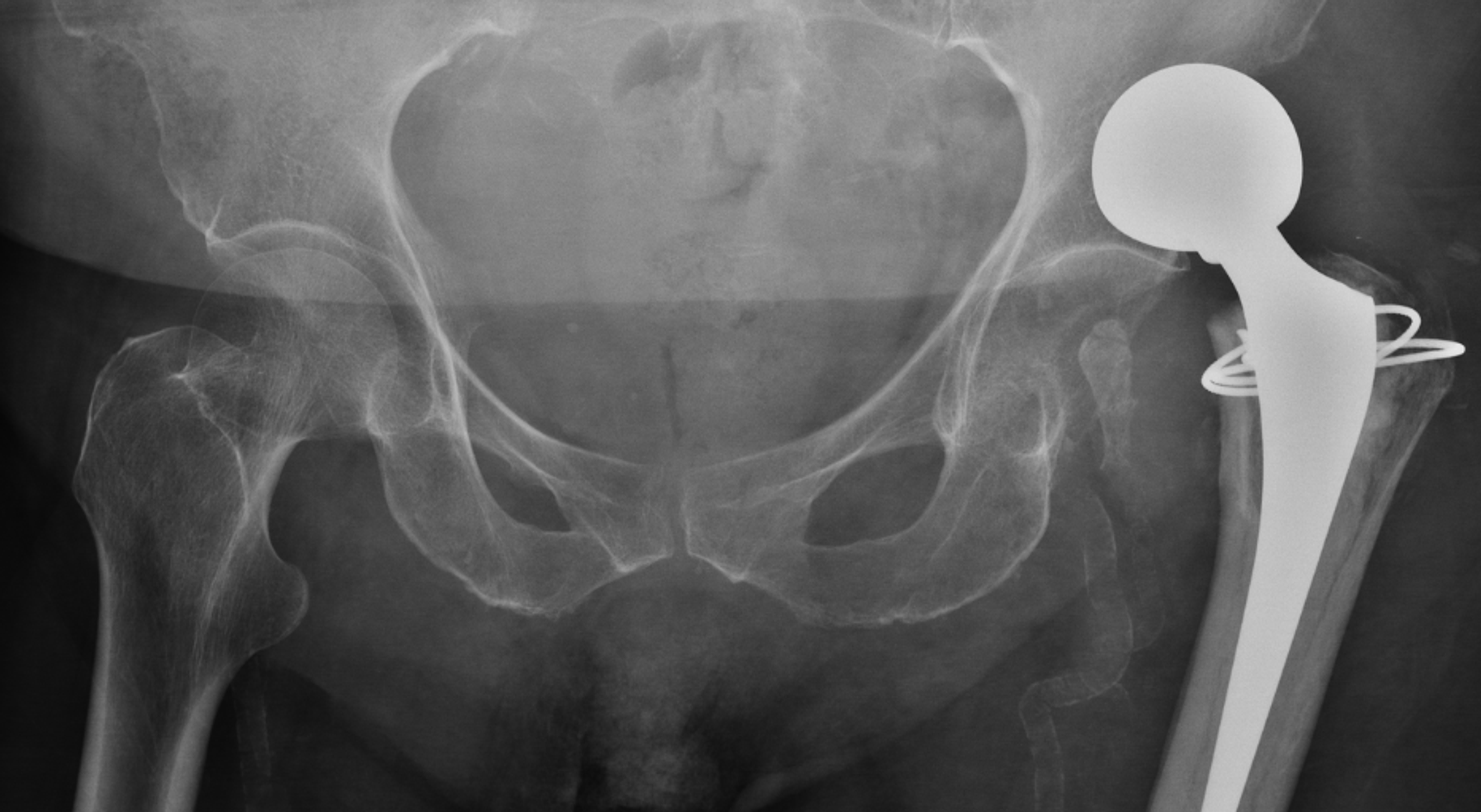 What Is Bipolar Hip Arthroplasty - Ideas of Europedias