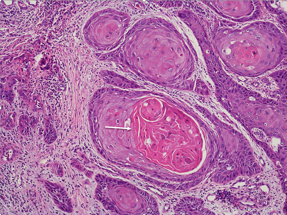 Cureus | A Case Report on Advanced Squamous Cell Carcinoma of the Penis