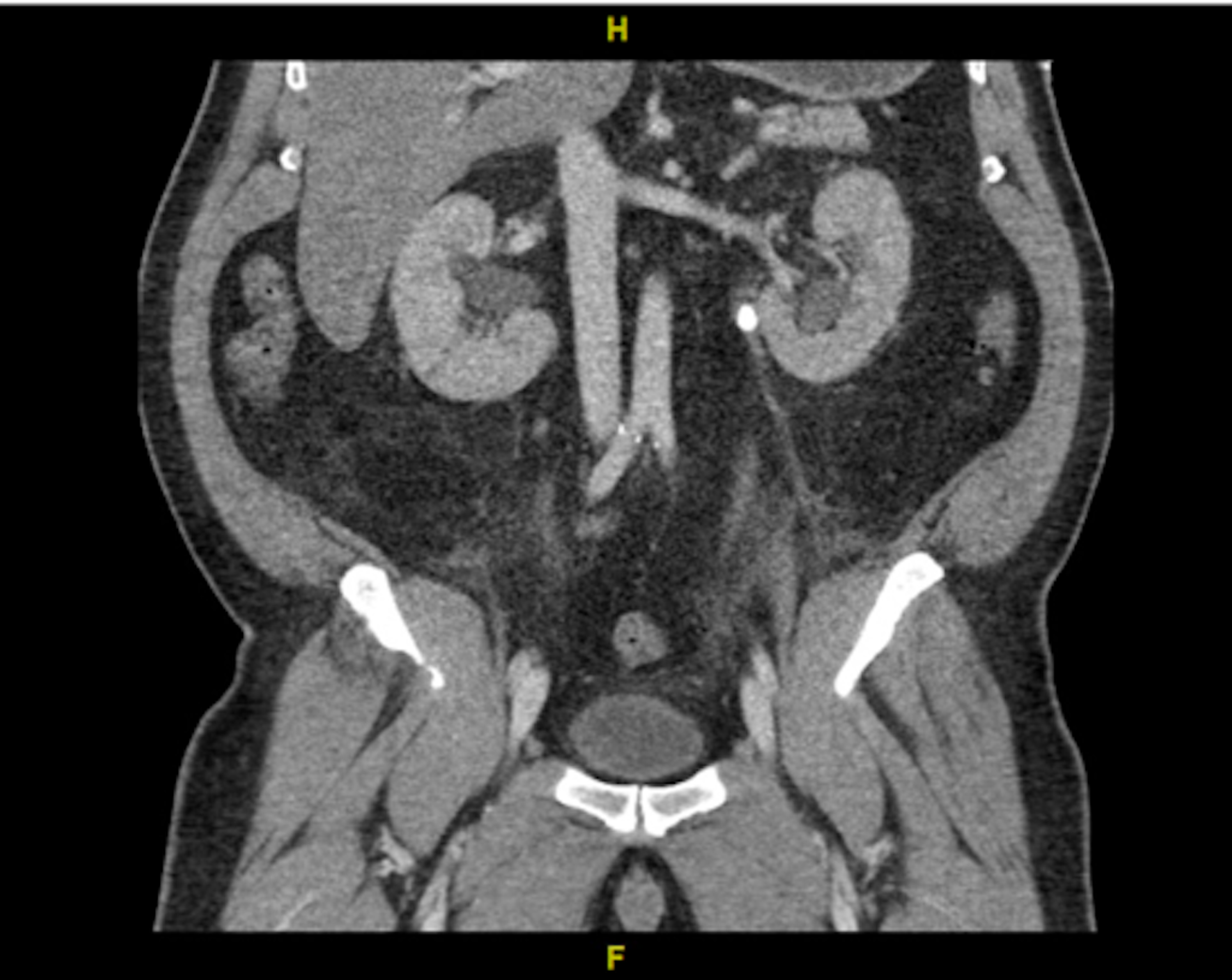 Cureus | Bilateral Ureteral Obstruction Causing Acute Kidney Injury And ...