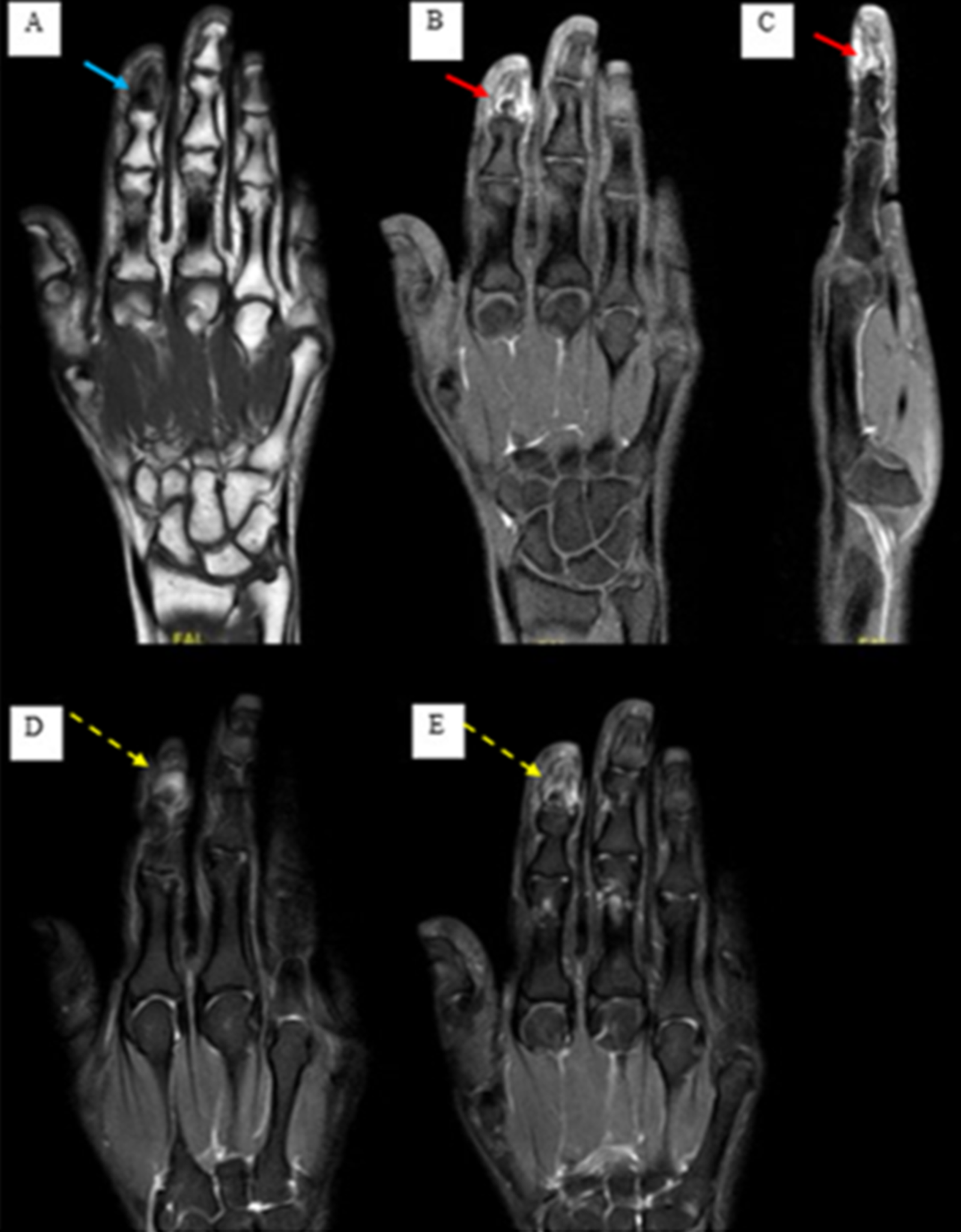 Cureus | Osteoid Osteoma of the Distal Phalanx: A Rare Condition