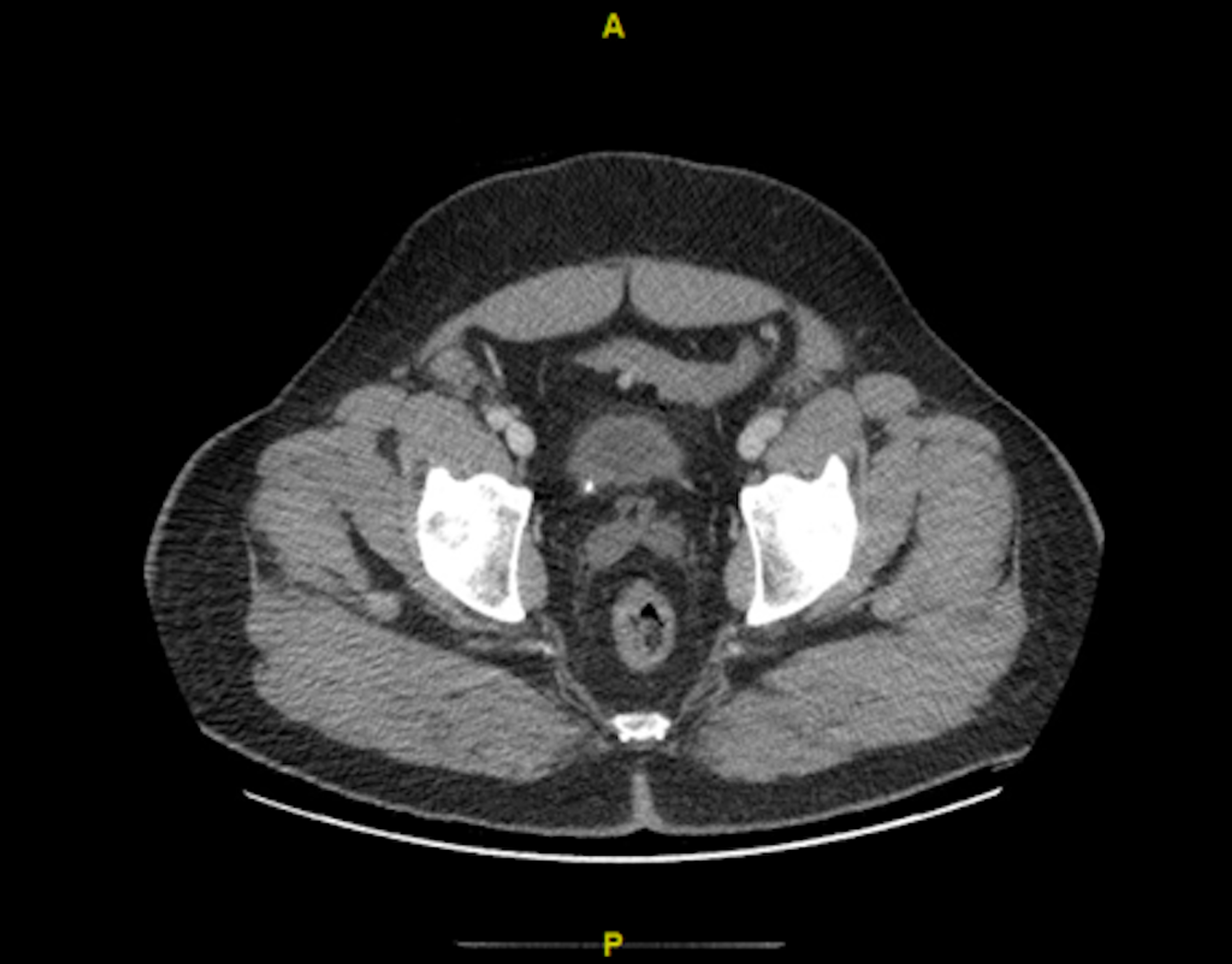 Cureus | Bilateral Ureteral Obstruction Causing Acute Kidney Injury And ...