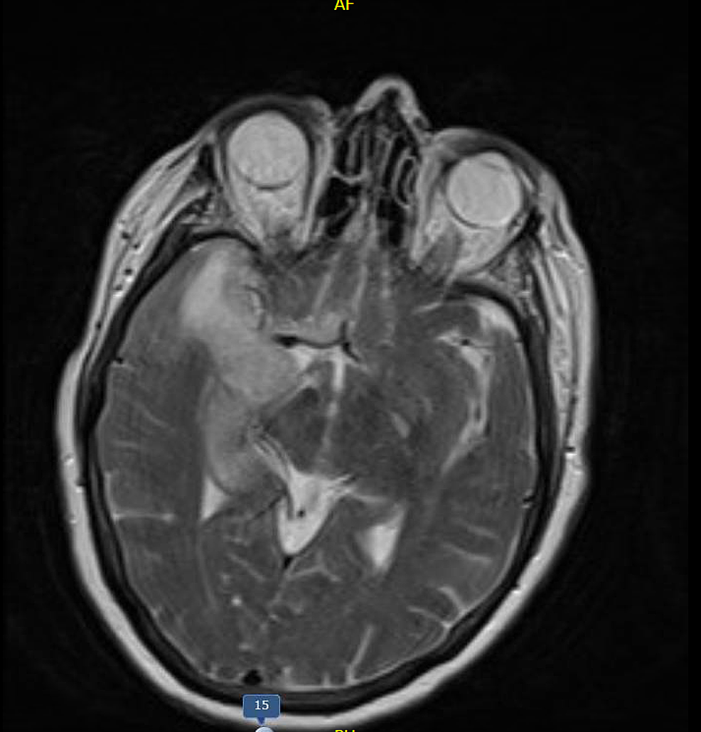 Cureus | Herpes Simplex Virus Encephalitis: Atypical Presentation as a ...