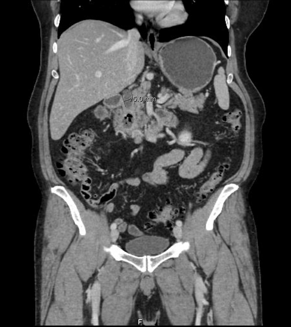 Lemmel Syndrome as a Rare Cause of Prolonged Right Hypochondrial Pain ...