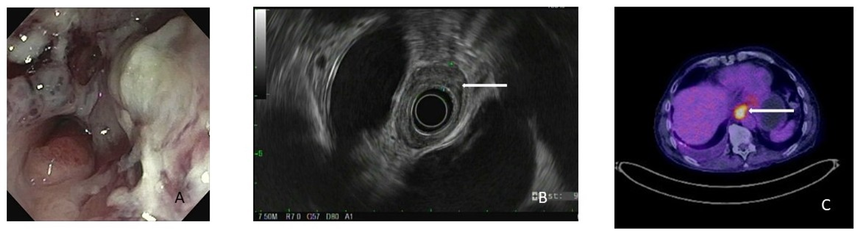 Cureus Clinical Predictors of Locally Advanced Pathology in Esophageal Adenocarcinoma