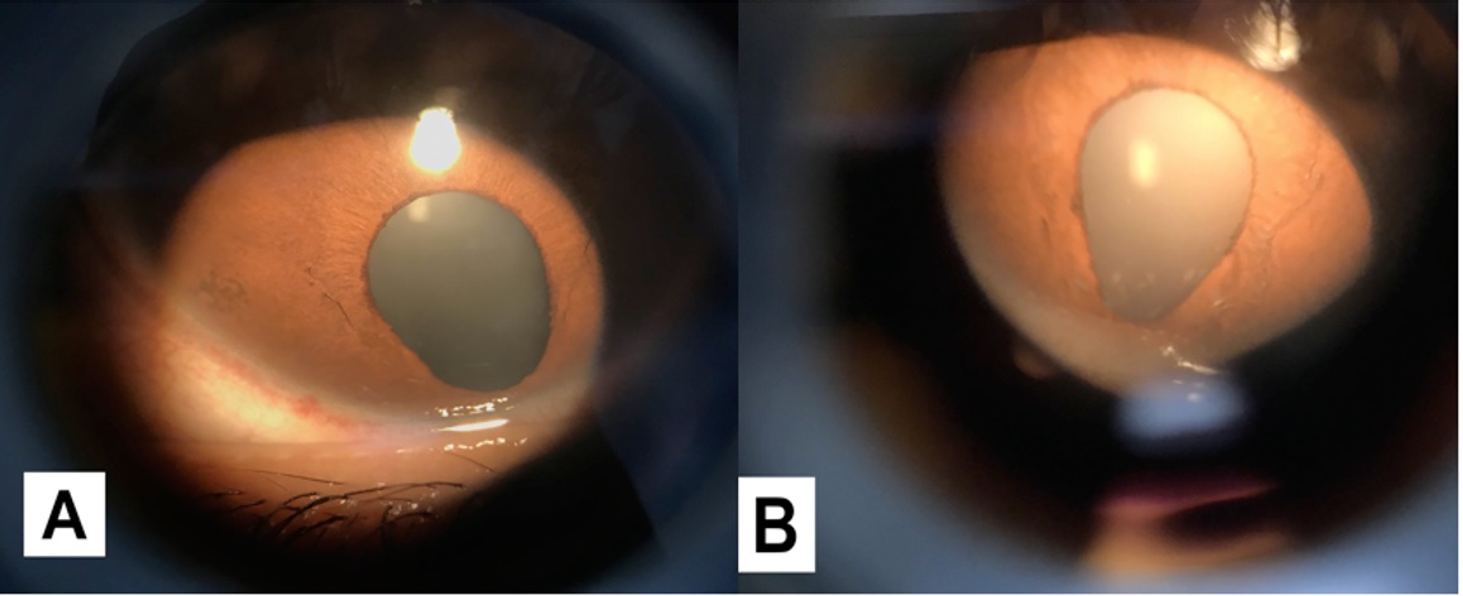 coloboma of the eye