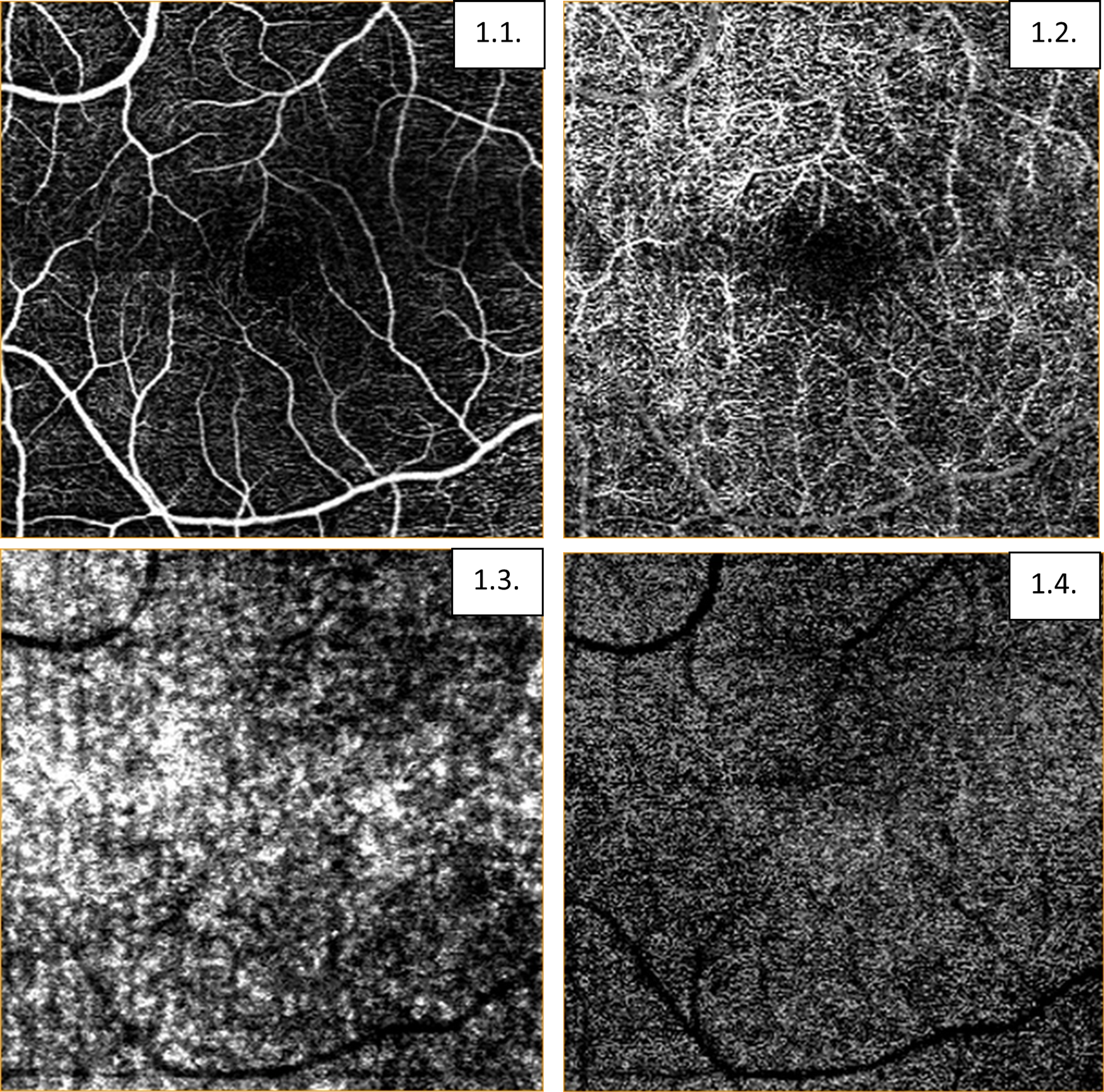 Cureus | Correlation Between Retrograde Trans-Synaptic Degeneration of  Ganglion Cells and Optical Coherence Tomography Angiography Following  Ischemic Stroke