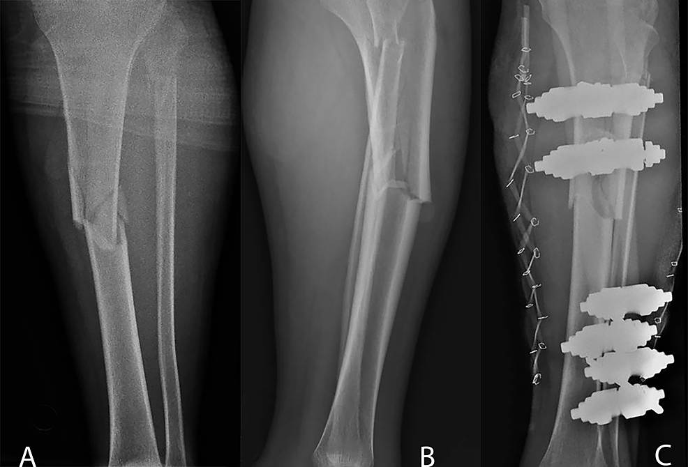 Cureus  Is It Compartment Syndrome? Two Case Reports and