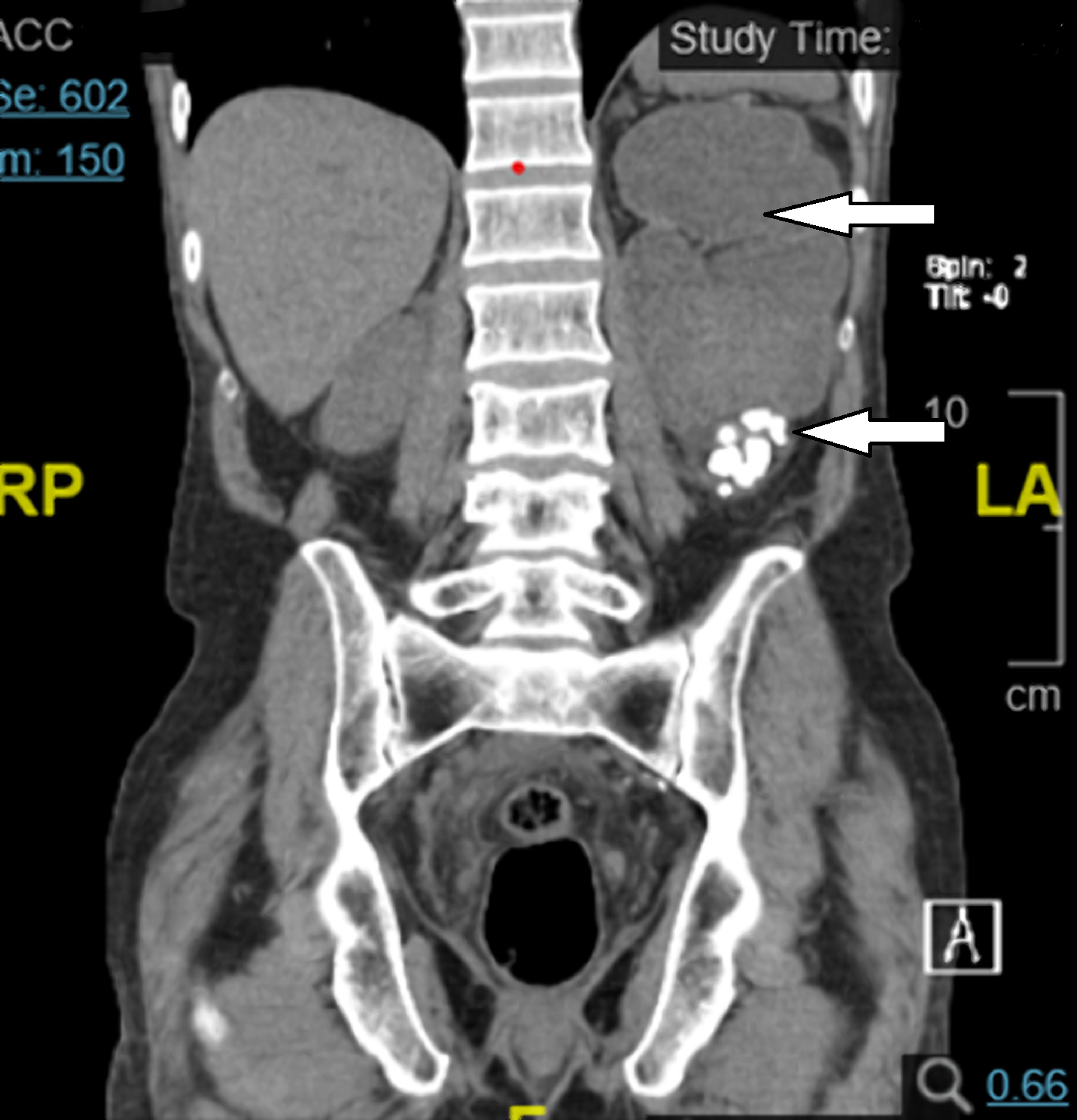 Cureus Upper Urinary Tract Urothelial Carcinoma With Squamous, Glandular, and