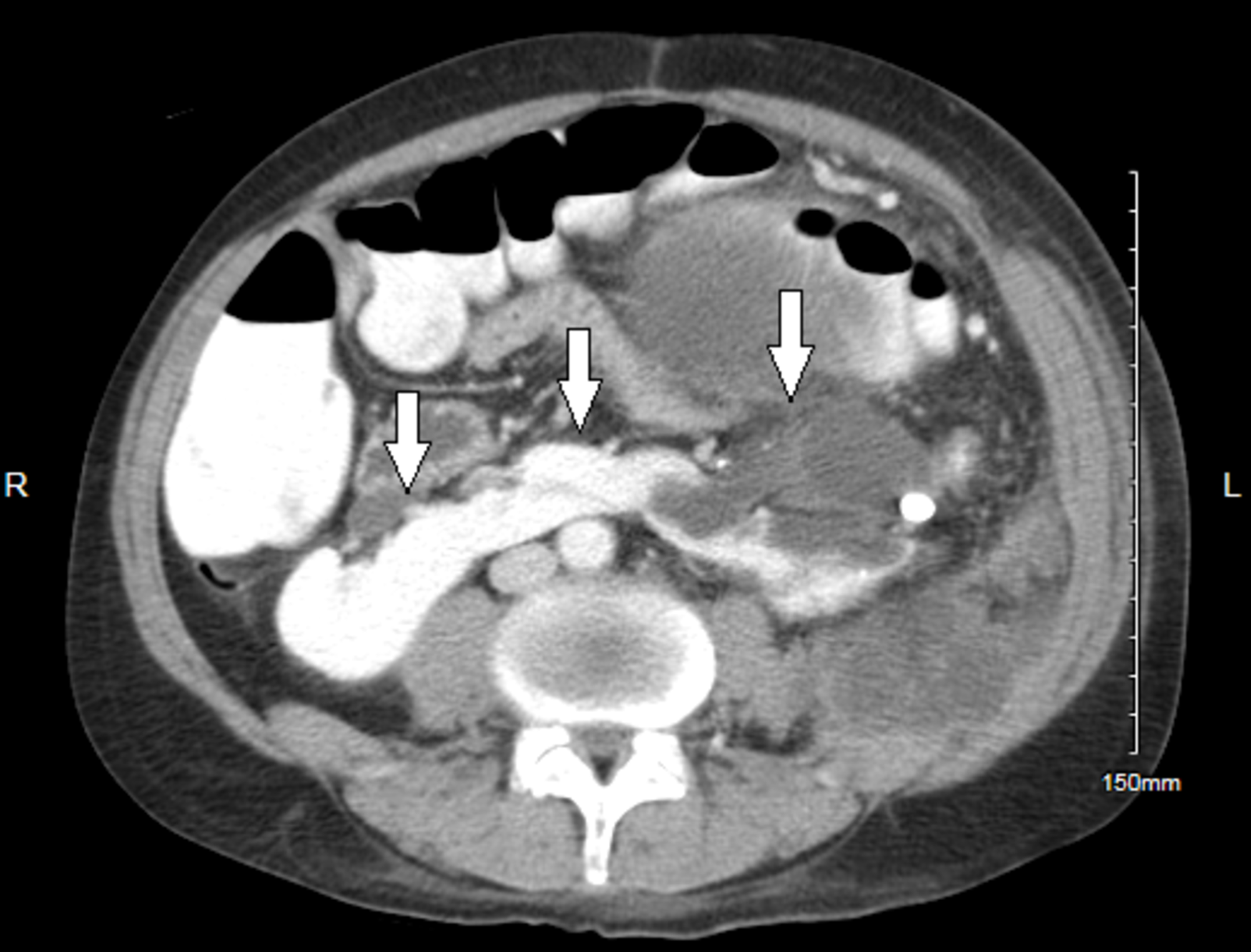 Cureus Upper Urinary Tract Urothelial Carcinoma With Squamous